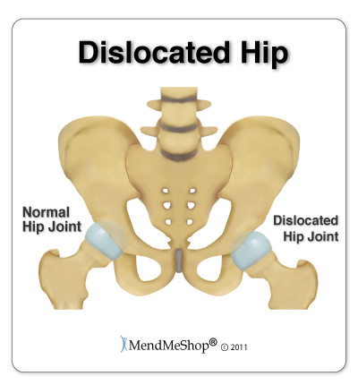 What are the symptoms of a displaced hip?